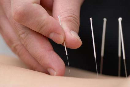 L’acupuncture chinoise : j’ai testé