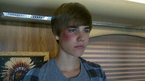 Justin Bieber ... Hospitalisé durgence