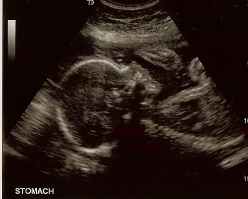 baby ultrasound_4