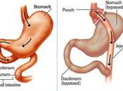 Chirurgie efficace pour diabète