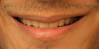 RENOV'SMILE : DES DENTS HALLUCINEMMENT PLUS BLANCHES !