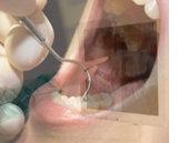 Parodontiste ou parodontologue : dentiste spécialiste des gencives
