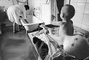 enfant malformé apres Chernobyl