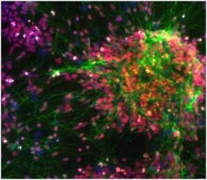 SCHIZOPHRÉNIE: Des cellules de peau aux neurones, des chercheurs franchissent le pas  – Nature