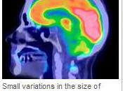 ALZHEIMER: L’IRM peut prévoir l’apparition premiers symptômes Neurology