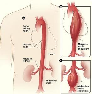 ANEVRYSME de l’AORTE: Des bactéries de la bouche à… l’aorte – Inserm-PloS ONE