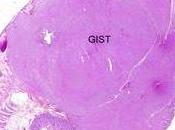 TUMEURS stromales gastro-intestinales (GIST): Découverte d’un facteur résistance traitement IGR-Nature Medicine
