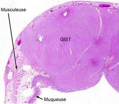 TUMEURS stromales gastro-intestinales (GIST): Découverte d’un facteur clé de résistance au traitement – IGR-Nature Medicine