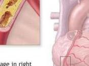 L’HYPERTENSION gagne jeunes adultes Epidemiology