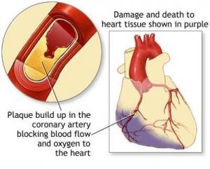 CRISE CARDIAQUE: La peur de mourir aggrave le risque de récidive  – European Heart Journal