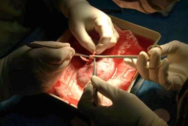Le rein : 1er organe greffé avec succés