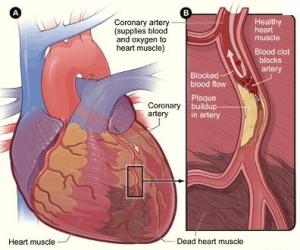 CRISE CARDIAQUE: Eviter 20% des décès grâce à un nouveau médicament – British Cardiovascular Society annual scientific Conference