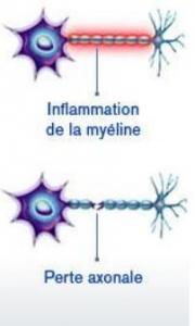 SCLÉROSE en plaques: Découverte d’Axin2, la protéine qui protège la myéline – Nature Neuroscience