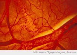 Occlusion de la rétine et CÉCITÉ: Des globules rouges un peu trop collants  – Inserm- Journal of Thrombosis and Haemostasis