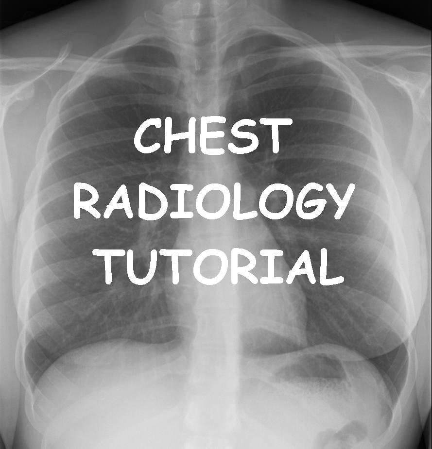 Radiographie Thoracique pour les Nuls - Chest X-ray Made easy