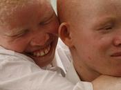 Cameroun-Asmodisa: albinos l'honneur vendredi