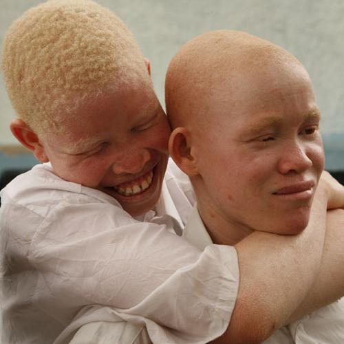 Cameroun-Asmodisa: Les albinos à l'honneur dès ce vendredi 