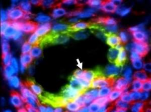 CANCER du SEIN: Des vaisseaux sanguins dans les tumeurs, facteurs de bon pronostic – Cancer Research