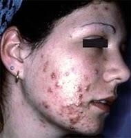 Comment soigner l'acné adulte