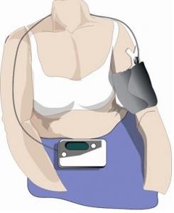 HYPERTENSION: La MAPA pour éviter le syndrome de la blouse blanche – The Lancet