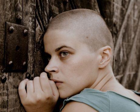 la calvitie homme et femme