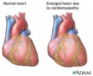 INSUFFISANCE CARDIAQUE: Le médicament qui réduit le volume du cœur – ESC Congress 2011