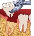 Dent arrachée : soins après extraction dentaire