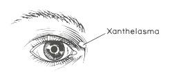Le XANTHELASMA sur la paupière, un signe de risque cardiaque – British Medical Journal