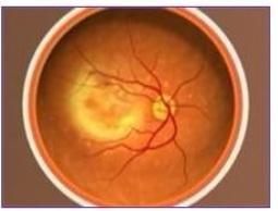 Trop d’ASPIRINE pourrait rendre aveugle – Opthalmology