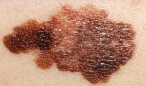 MÉLANOME: Des bêta-bloquants pour le cancer de la peau? – Cancer, Epidemiology, Biomarkers & Prevention