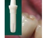 Titane implants dentaires allergie enfin reconnue