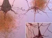 ALZHEIMER: gènes suppresseurs pour futures thérapies géniques? Science