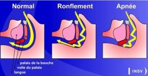 APNÉE du sommeil: L’efficacité du régime méditerranéen  – European Respiratory Journal