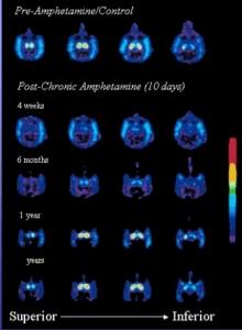 AMPHÉTAMINES à l’adolescence, troubles neurologiques irréversibles  – International Journal of Neuropsychopharmacology