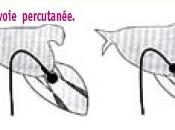 VALVES aortiques TRANSCUTANÉES: pour poursuite leur prise charge Haute Autorité santé