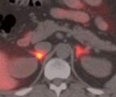 Hypertension et SYNDROME de CONN: Diagnostiquer par PET scan – Journal of Clinical Endocrinology & Metabolism