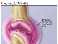 Bouts faciles pour le soulagement de douleur normal d'arthrite