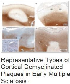 SCLÉROSE en plaques: Découverte d’un nouveau mode de progression de la maladie – New England Journal of Medicine