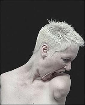 ALISON LAPPER, une leçon de vie !