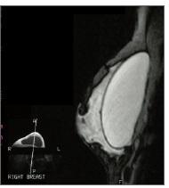 IMPLANTS MAMMAIRES PIP: La FDA les avait répudiés depuis 2000! – FDA
