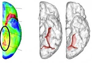 SCHIZOPHRÉNIE: La perte de matière grise identifiée comme typique de la maladie – Archives of General Psychiatry