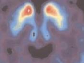 Maladie PARKINSON: facteurs prédicteurs survie Archives Neurology