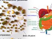 Cure Foie Vésicule Biliaire