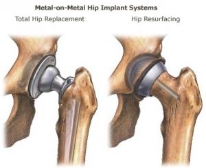 PROTHÈSES de HANCHE: Du lubrifiant industriel dans les articulations – Science