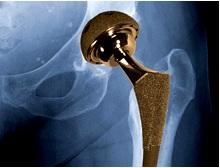 PROTHÈSES de HANCHE: Du lubrifiant industriel dans les articulations – Science