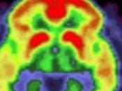 Maladie d’ALZHEIMER: Précoce tardive, mêmes gènes sont cause PLoS