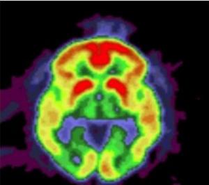 Maladie d’ALZHEIMER: Précoce ou tardive, de mêmes gènes sont en cause – PLoS ONE