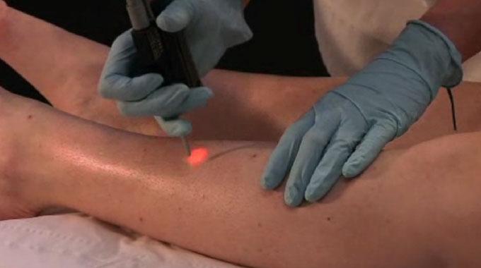image d'un médecin pratiquant l'épilation laser