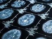 ALZHEIMER: bexarotène, nouveau médicament candidat? Science