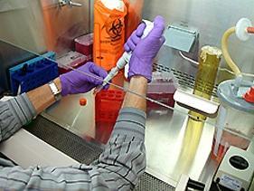 PARKINSON: Premier succès de remplacement de neurones par cellules souches – Journal of Parkinson’s Disease